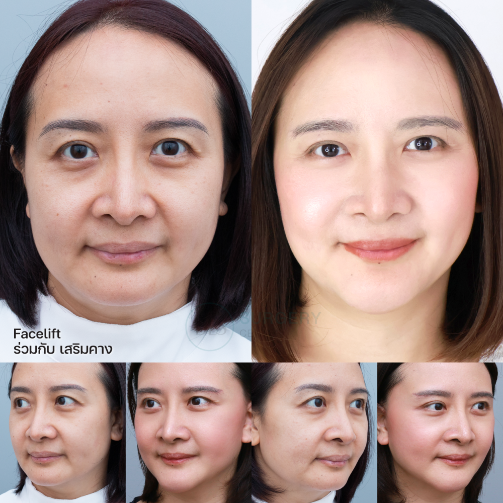 ดึงหน้า Facelift ร่วมกับ เสริมคาง