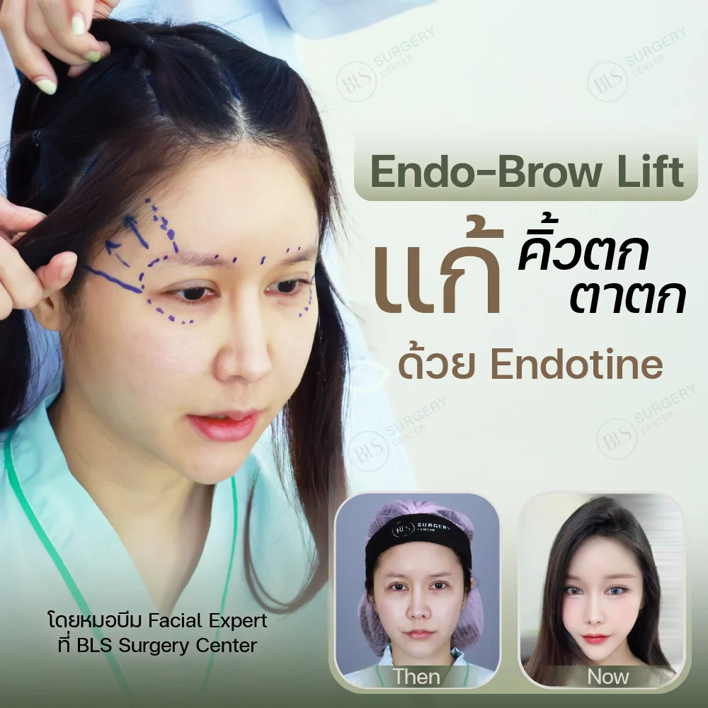 Endo-Brow Lift แก้ คิ้วตก ตาตก ด้วย Endotine