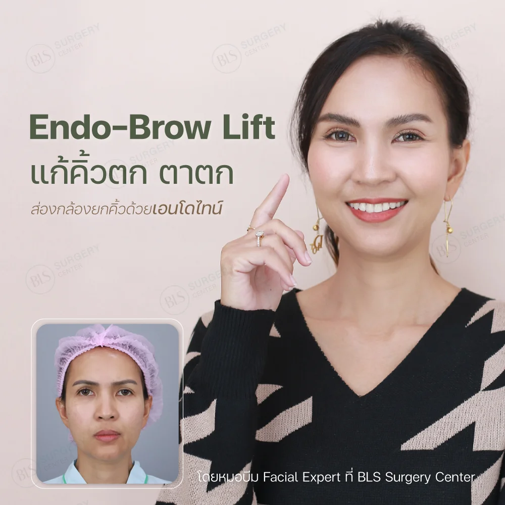 Endo-Brow Lift แก้คิ้วตก ตาตก ส่องกล้องยกคิ้วด้วยเอนโดไทน์