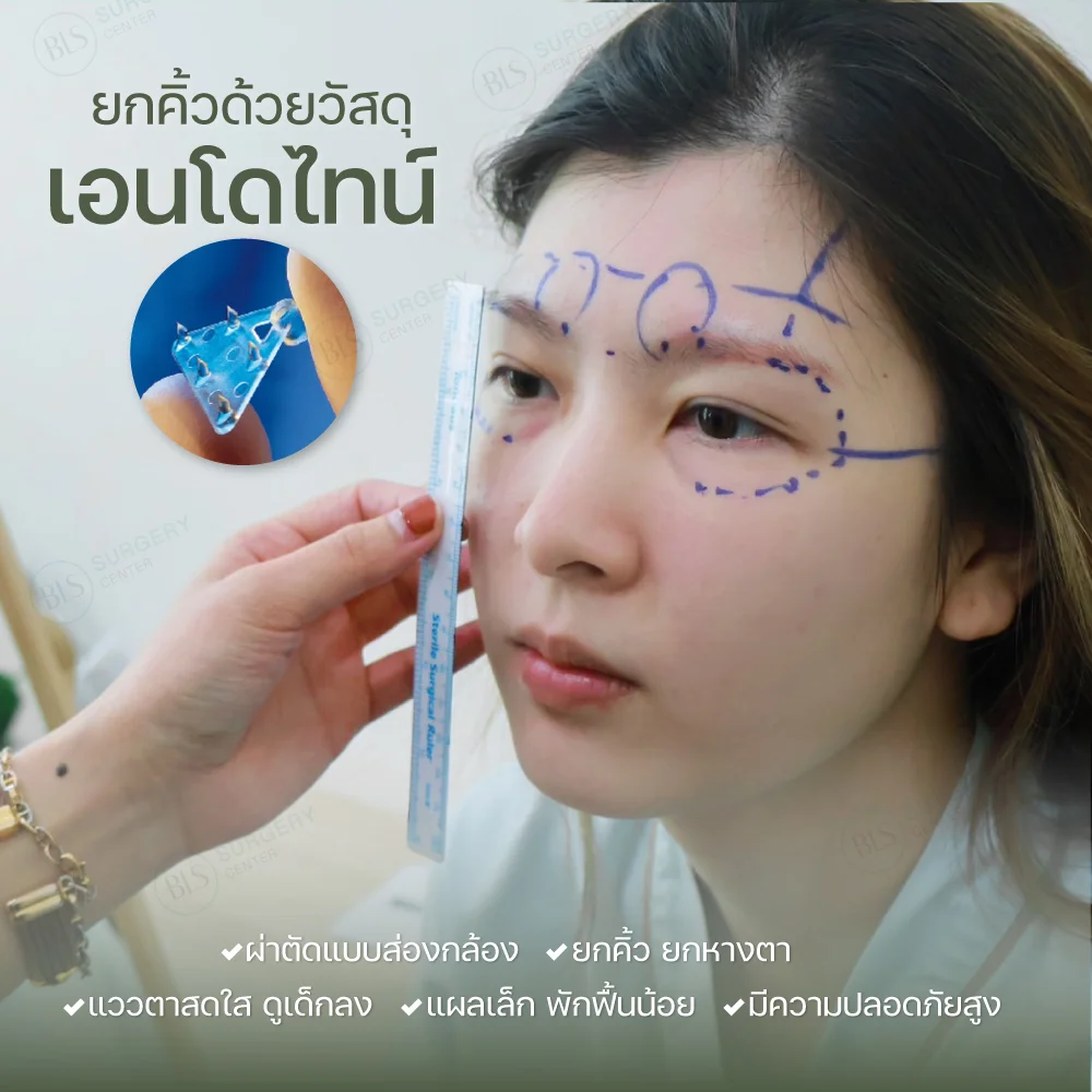 วัสดุ Endotine ใช้สำหรับการยกคิ้วด้วยเทคนิค Endobrow Lift