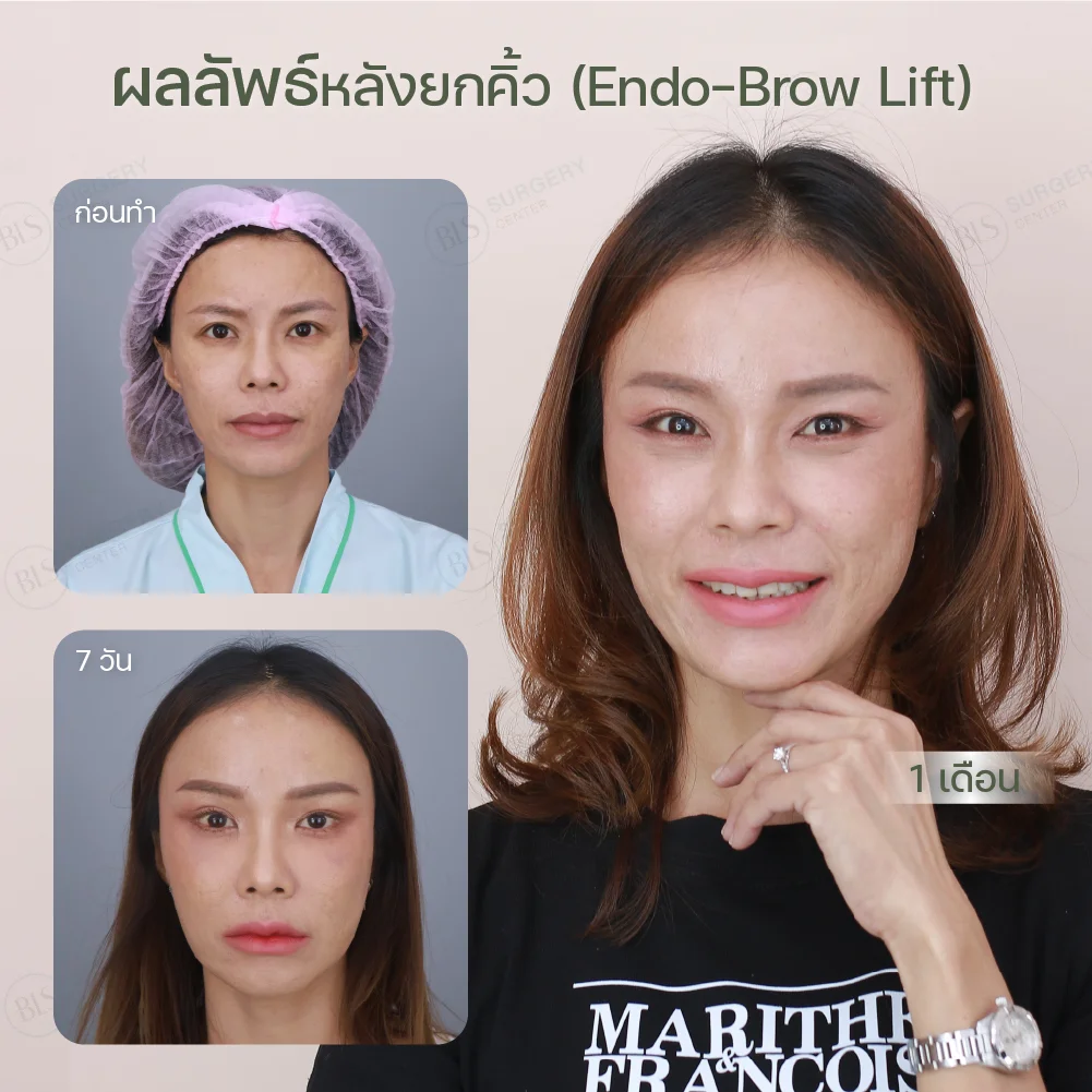 ผลลัพธ์หลังยกคิ้ว Endobrow Lift