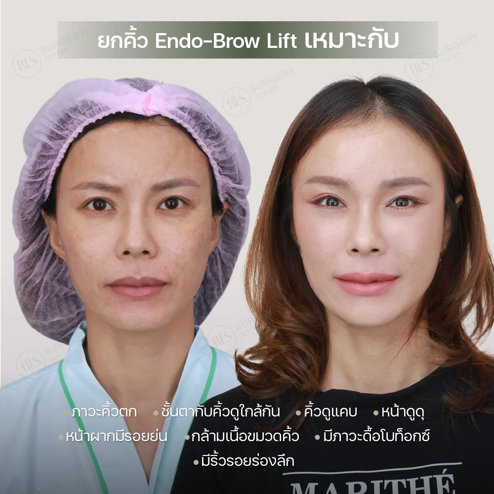 การทำ Endobrow Lift เหมาะกับใคร?