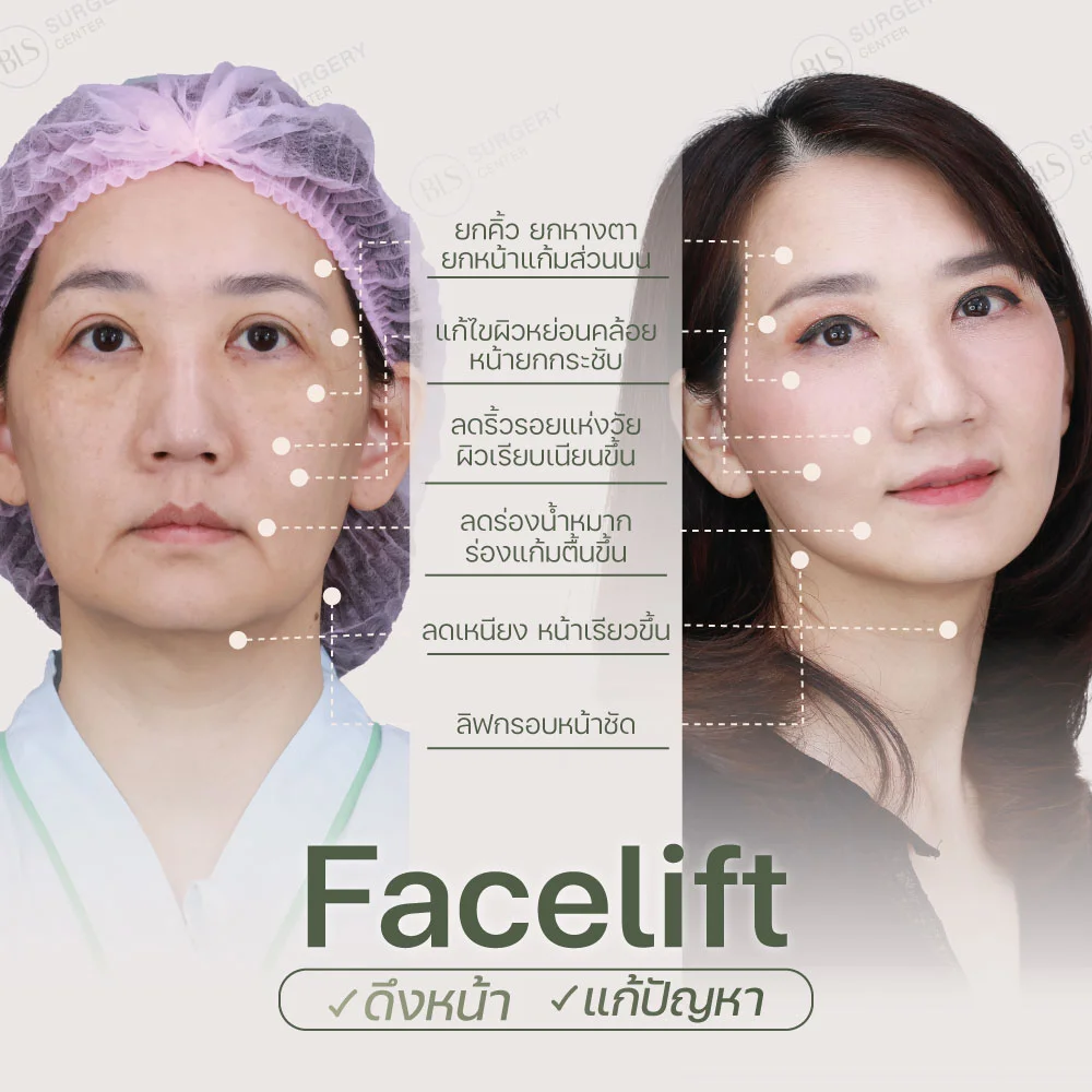 Facelift แก้ปัญหาอะไรได้บ้าง?