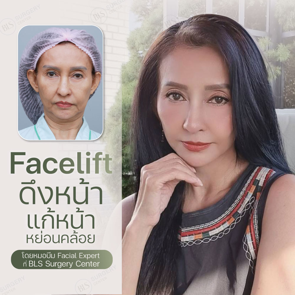 Facelift ดึงหน้า แก้หน้าหย่อนคล้อย