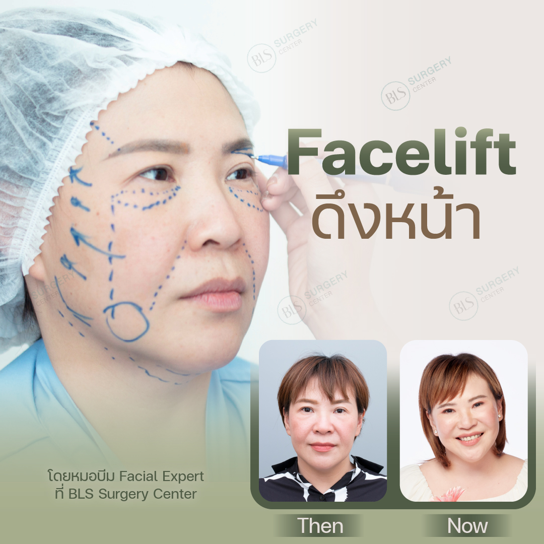 Facelift ดึงหน้า แก้หน้าหย่อนคล้อย