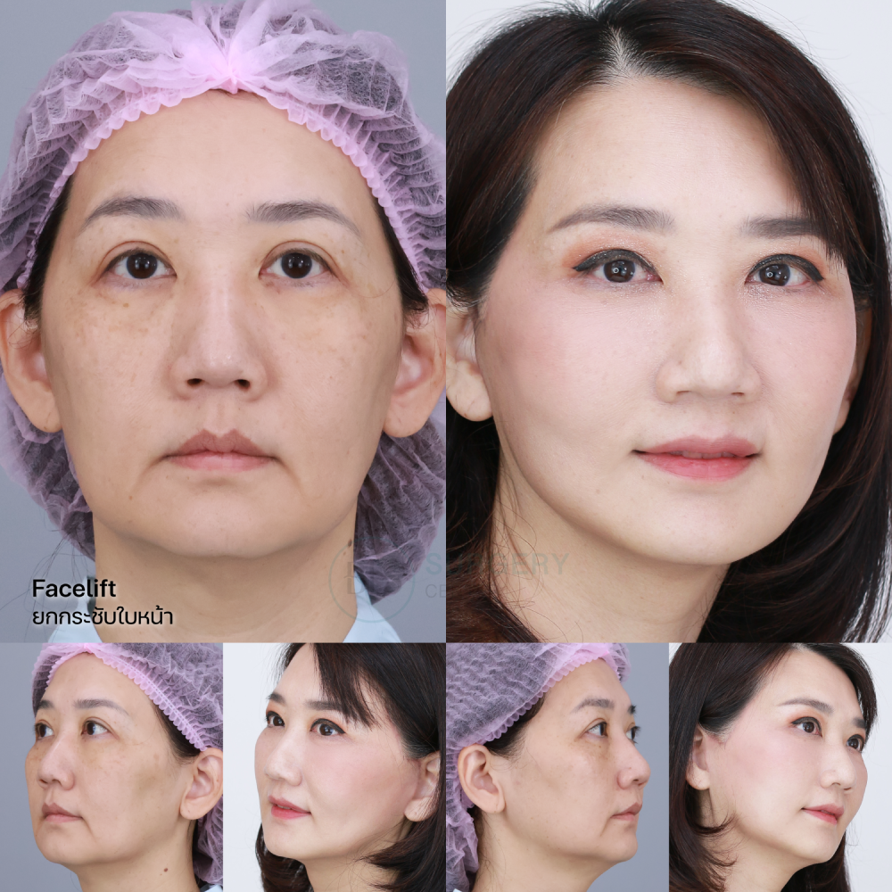 รีวิว ดึงหน้า Facelift