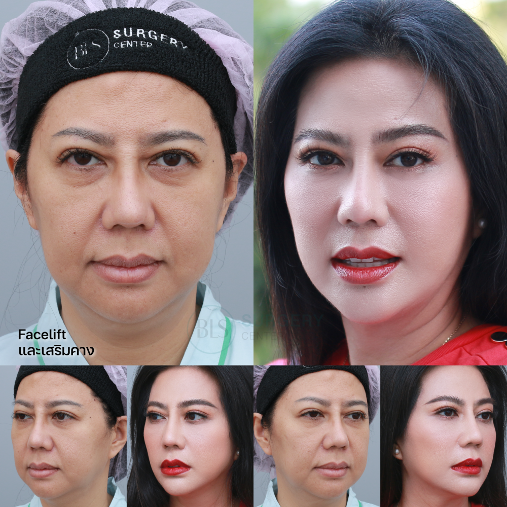 ดึงหน้า Facelift ร่วมกับ เสริมคาง