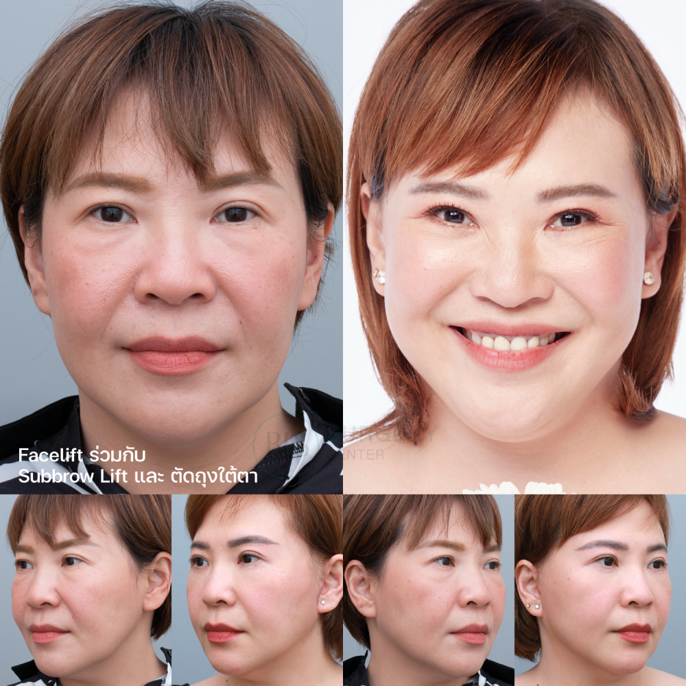 รีวิว ดึงหน้า Facelift ร่วมกับ แก้หนังตาตก Subbrow Lift และ ตัดถุงใต้ตา