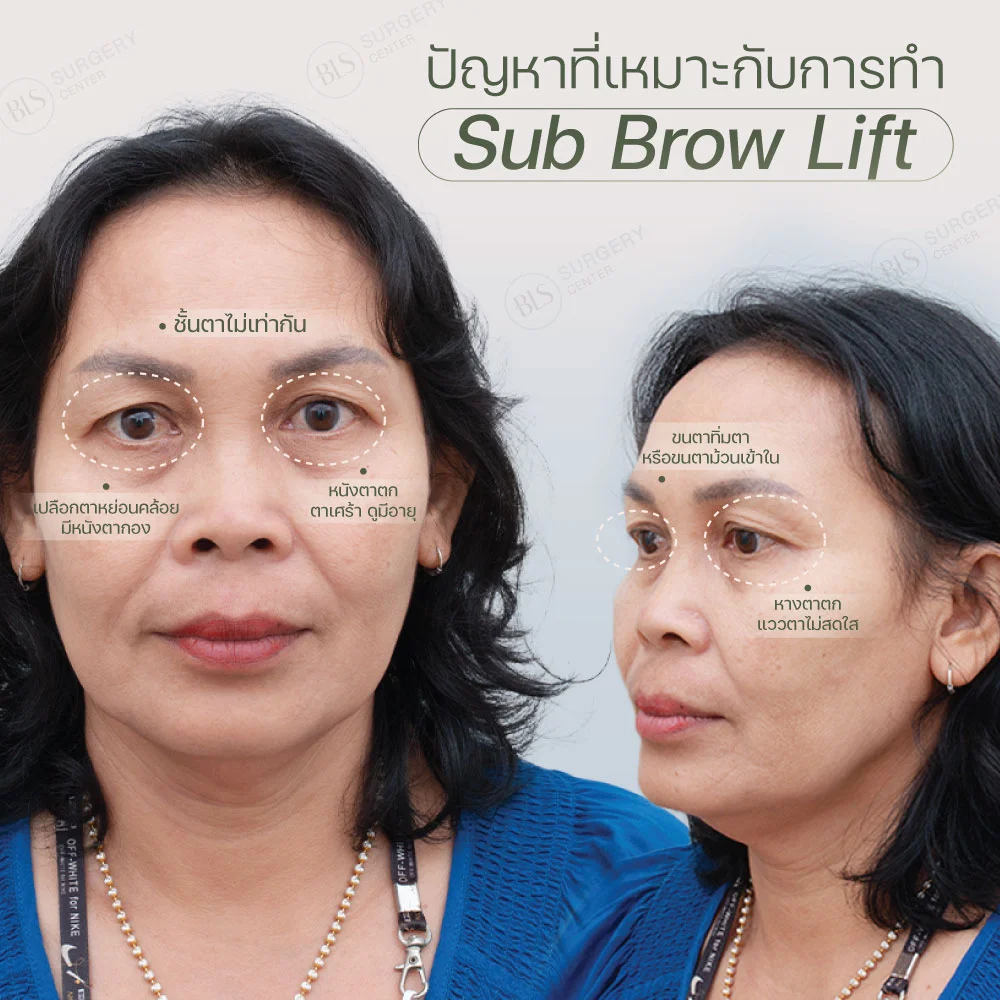 ปัญหาที่เหมาะกับการทำ Sub Brow Lift | แก้หนังตาตก