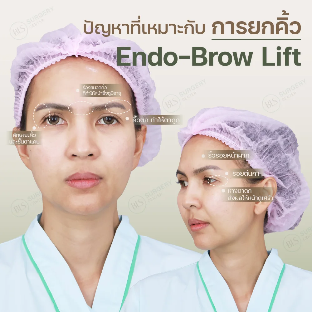 ปัญหาที่เหมาะกับการทำ Endobrow Lift