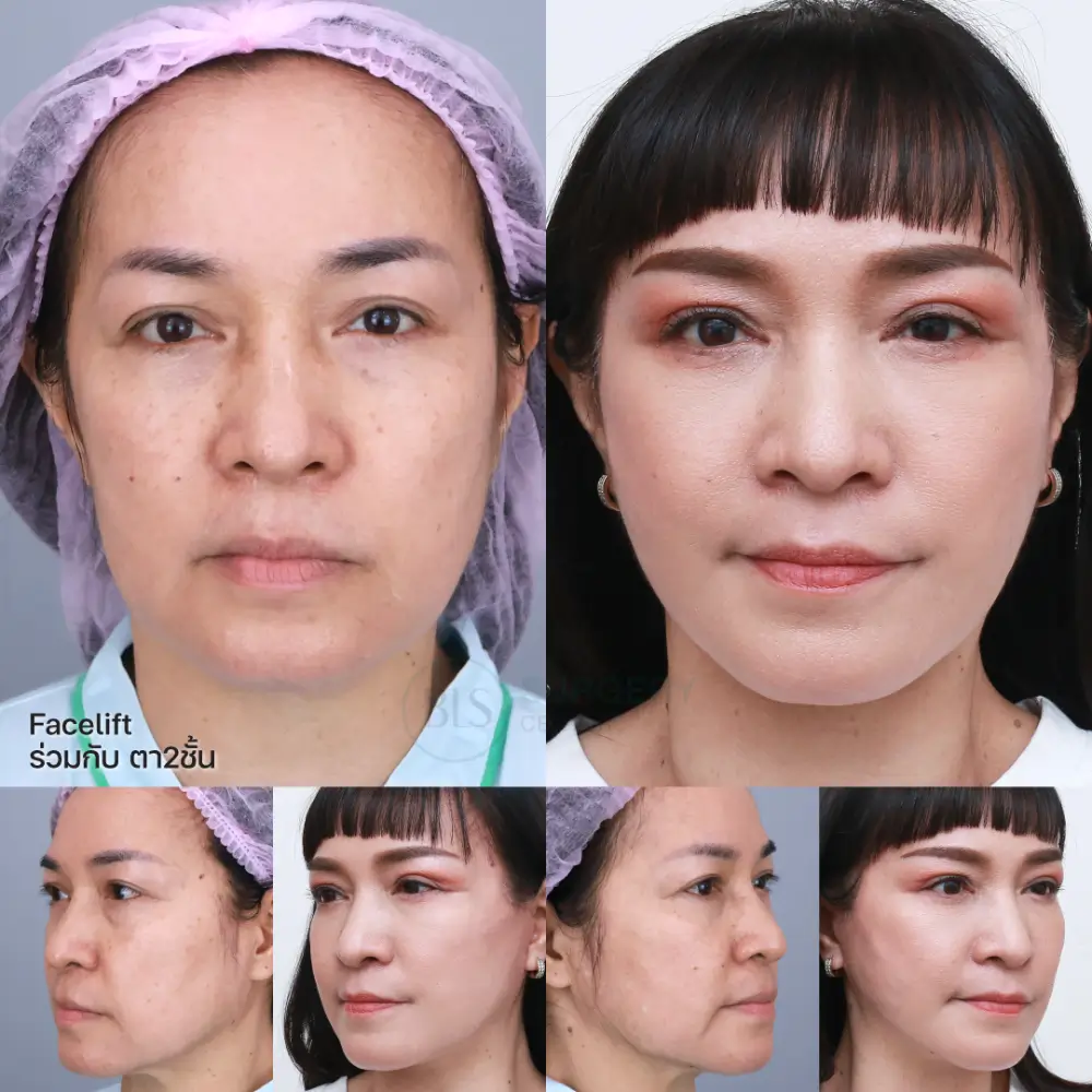 Eyelids ดึงหน้า Facelift ร่วมกับ ตา 2 ชั้น