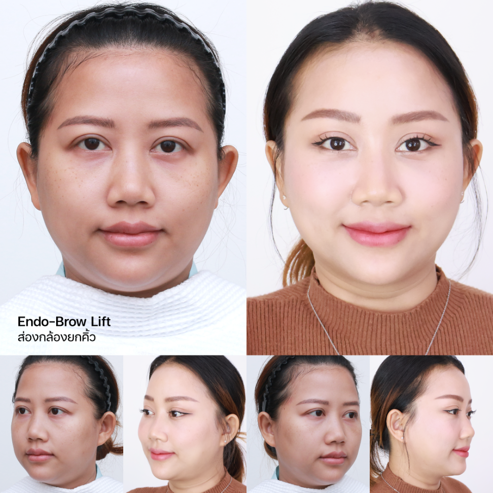 Endo-Brow Lift ส่องกล้องยกคิ้ว