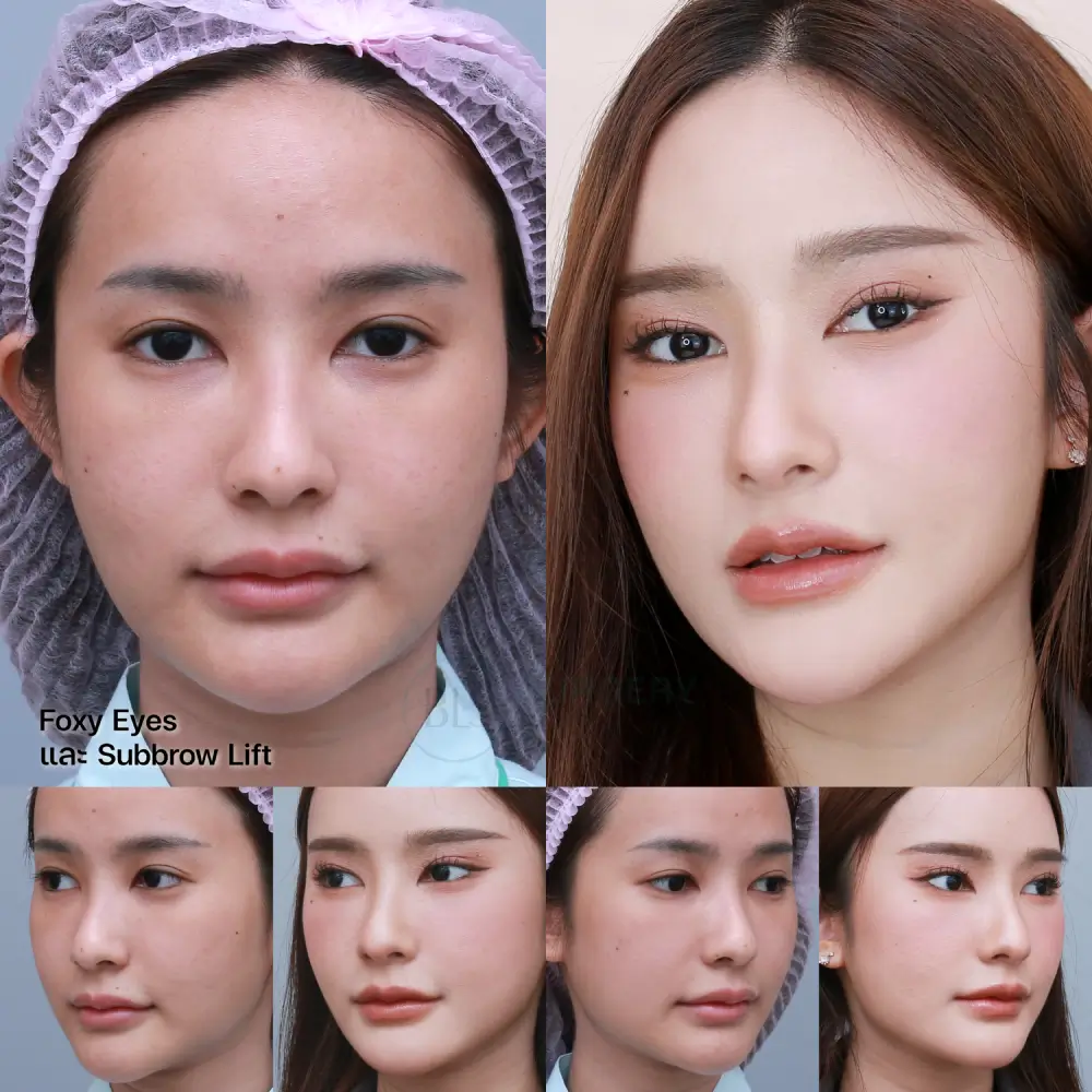 ยกหางตา Foxy Eyes ร่วมกับ แก้หนังตาตก Subbrow Lift