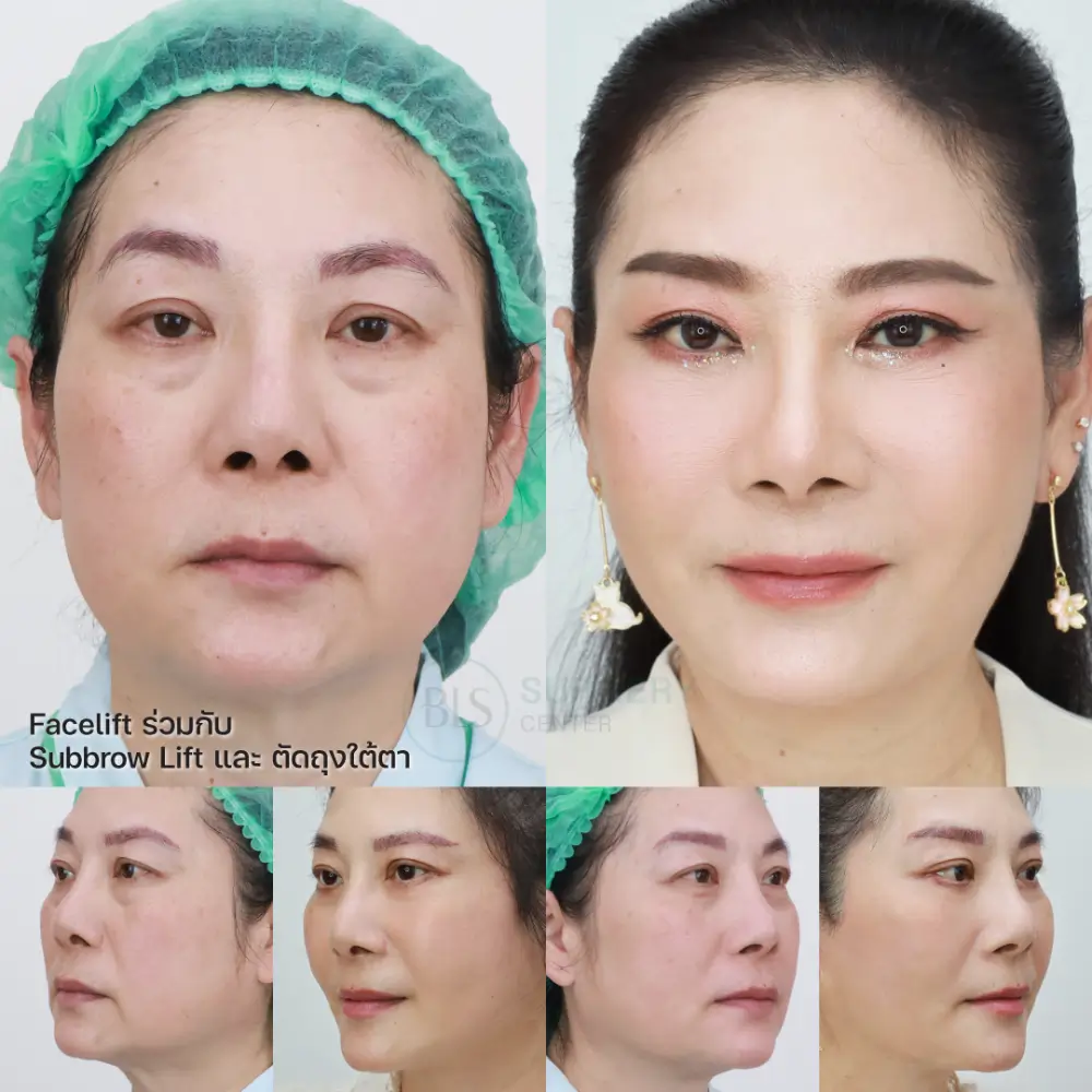 ดึงหน้า Facelift ร่วมกับ แก้หนังตาตก Subbrow Lift และ ตัดถุงใต้ตา