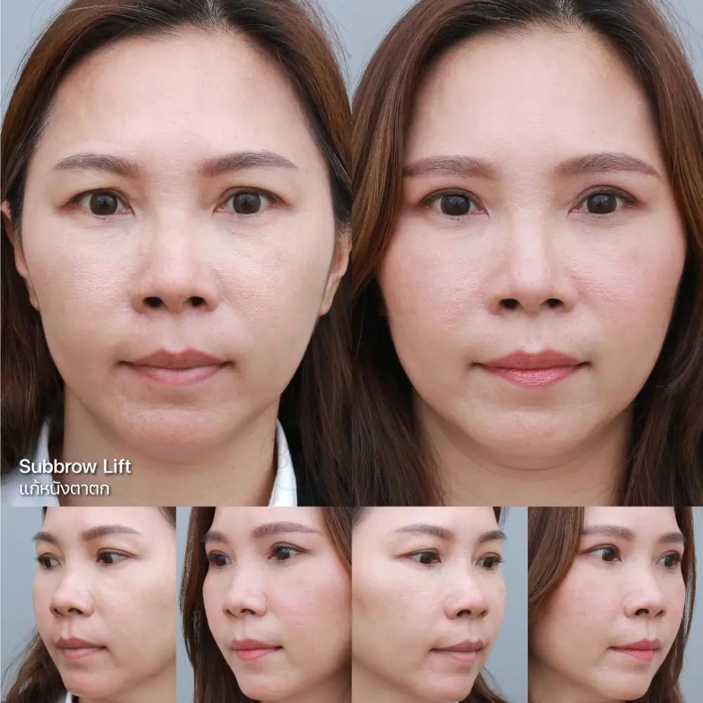 แก้หนังตาตก Subbrow Lift