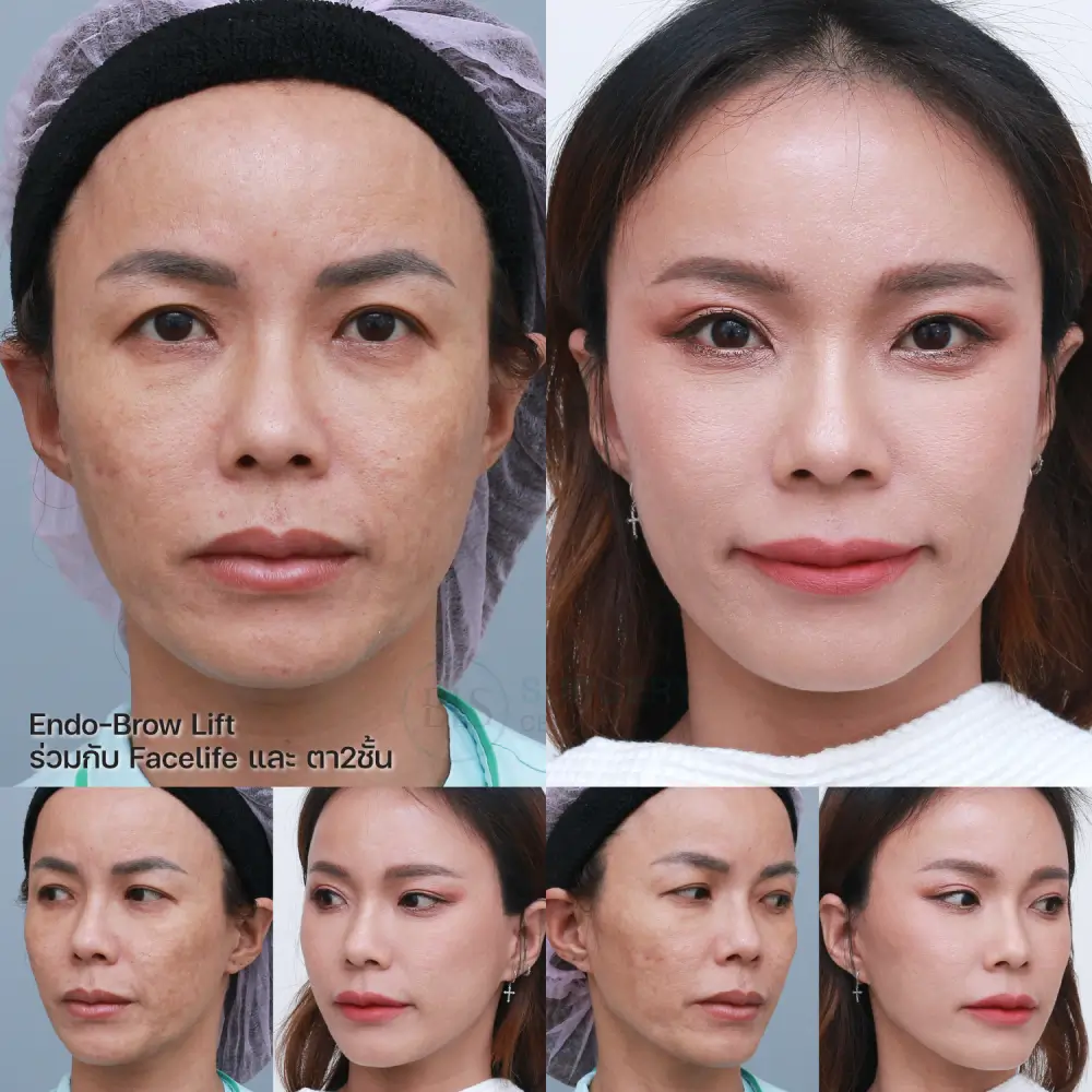 Endo-Browlift ร่วมกับ ดึงหน้า Facelift และ ตา 2 ชั้น