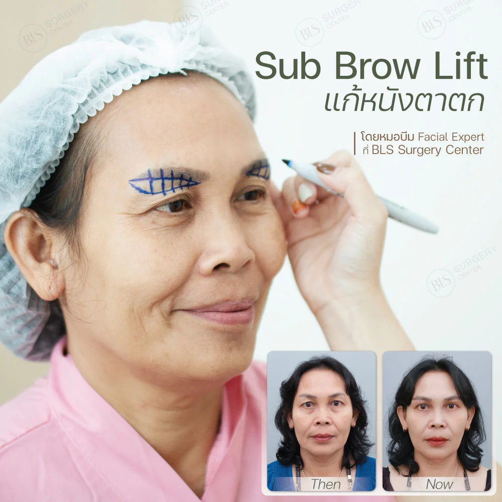 Subbrow Lift แก้หนังตาตก