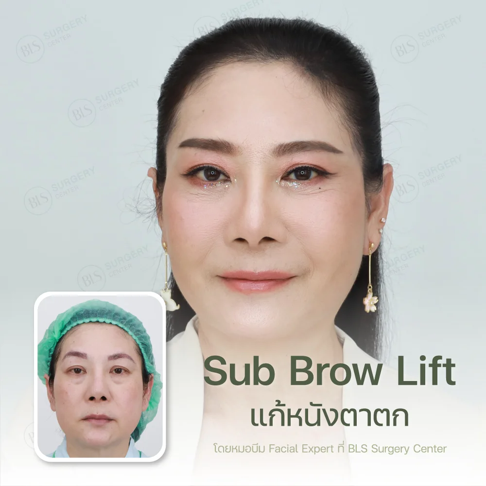 Subbrow Lift แก้หนังตาตก