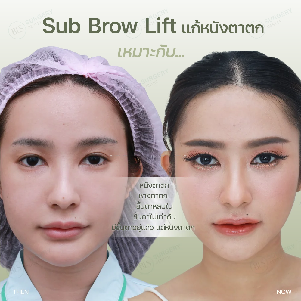 การทำ Sub Brow Lift เหมาะกับใคร | แก้หนังตาตก