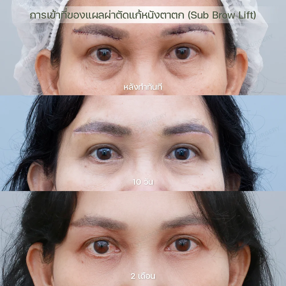 การเข้าที่ของแผล หลังทำ Sub Brow Lift | แก้หนังตาตก