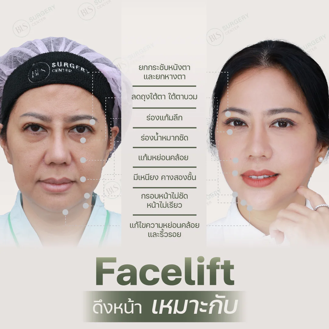 การยกกระชับหน้าด้วย Facelift เหมาะกับใคร?