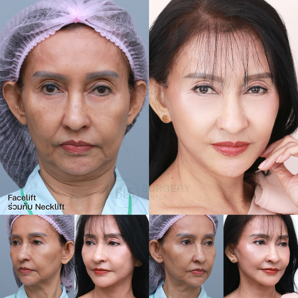 ดึงหน้า Facelift ร่วมกับ ดึงลำคอ Necklift