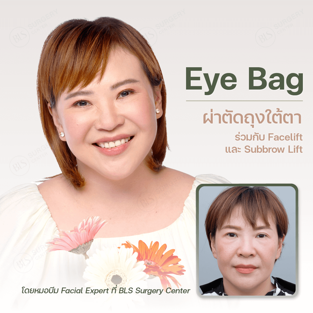 ผ่าตัดถุงใต้ตา หรือ ตัดถุงไขมันใต้ตา ตกแต่งหนังตาล่าง (Lower Blepharoplasty)