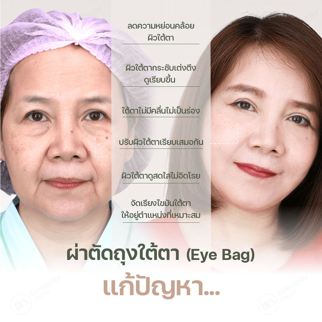 ผ่าตัดถุงใต้ตา แก้ปัญหาอะไรได้บ้าง?