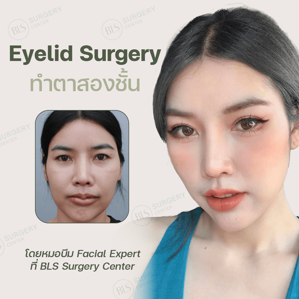 Eyelid Surgery ทำตาสองชั้น แก้ตาหลบใน