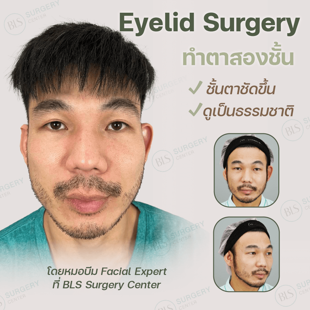 Eyelid Surgery ทำตาสองชั้น แก้ตาหลบใน ชั้นตาชัดขึ้น ดูเป็นธรรมชาติแบบผู้ชาย