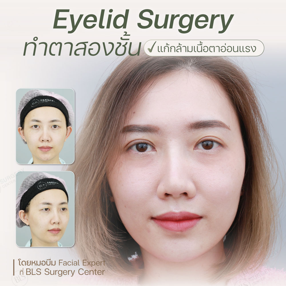 Eyelid Surgery ทำตาสองชั้น กรีดยาว แก้กล้ามเนื้อหนังตาอ่อนแรง