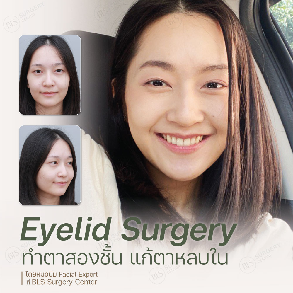 Eyelid Surgery ทำตาสองชั้น แก้ตาหลบใน