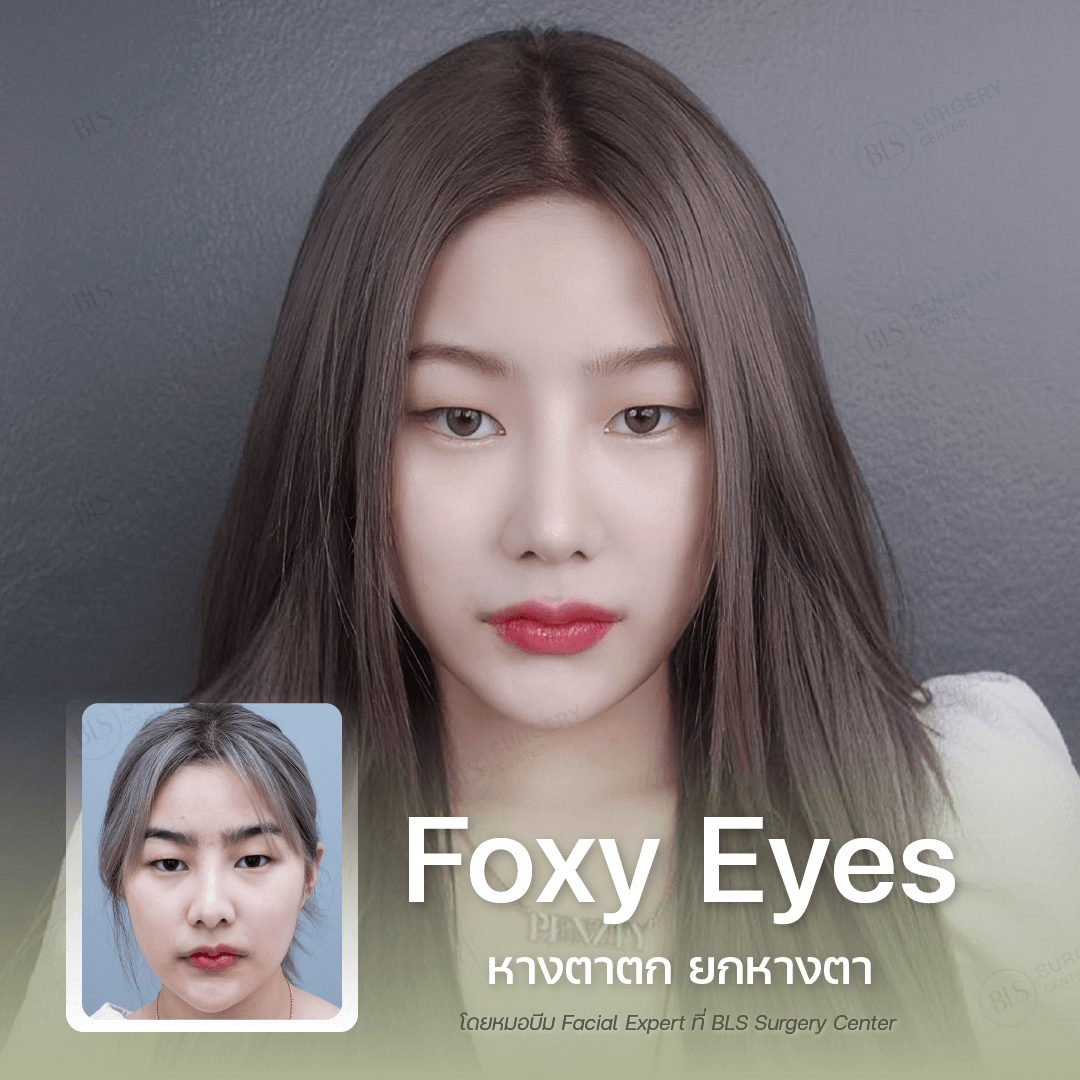 หางตาตก ยกหางตา ( Foxy Eyes )