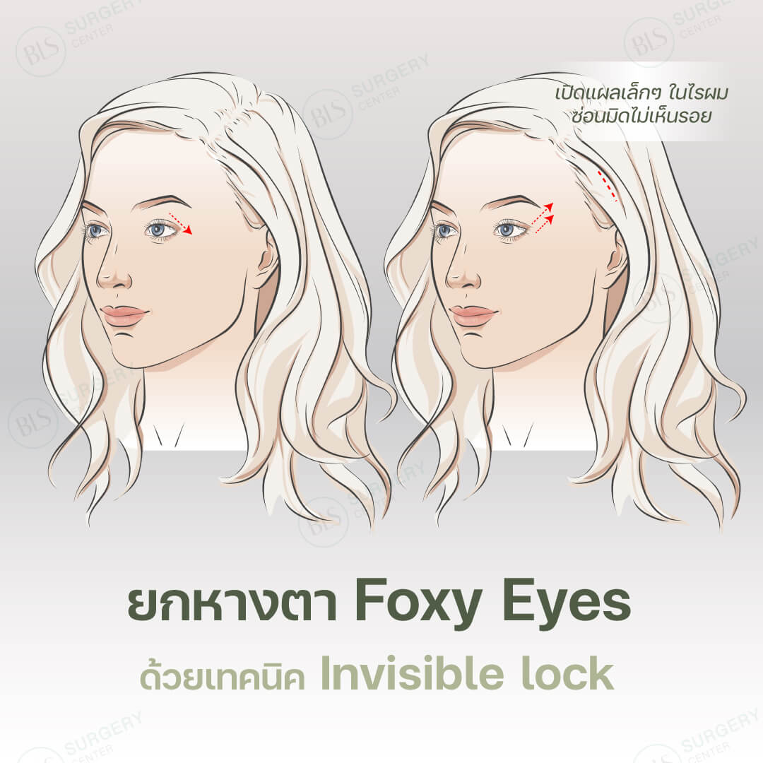 ยกหางตา (Foxy Eyes) ด้วยเทคนิค Invisible lock