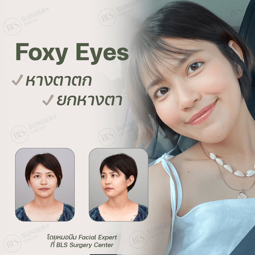 หางตาตก ยกหางตา ( Foxy Eyes )