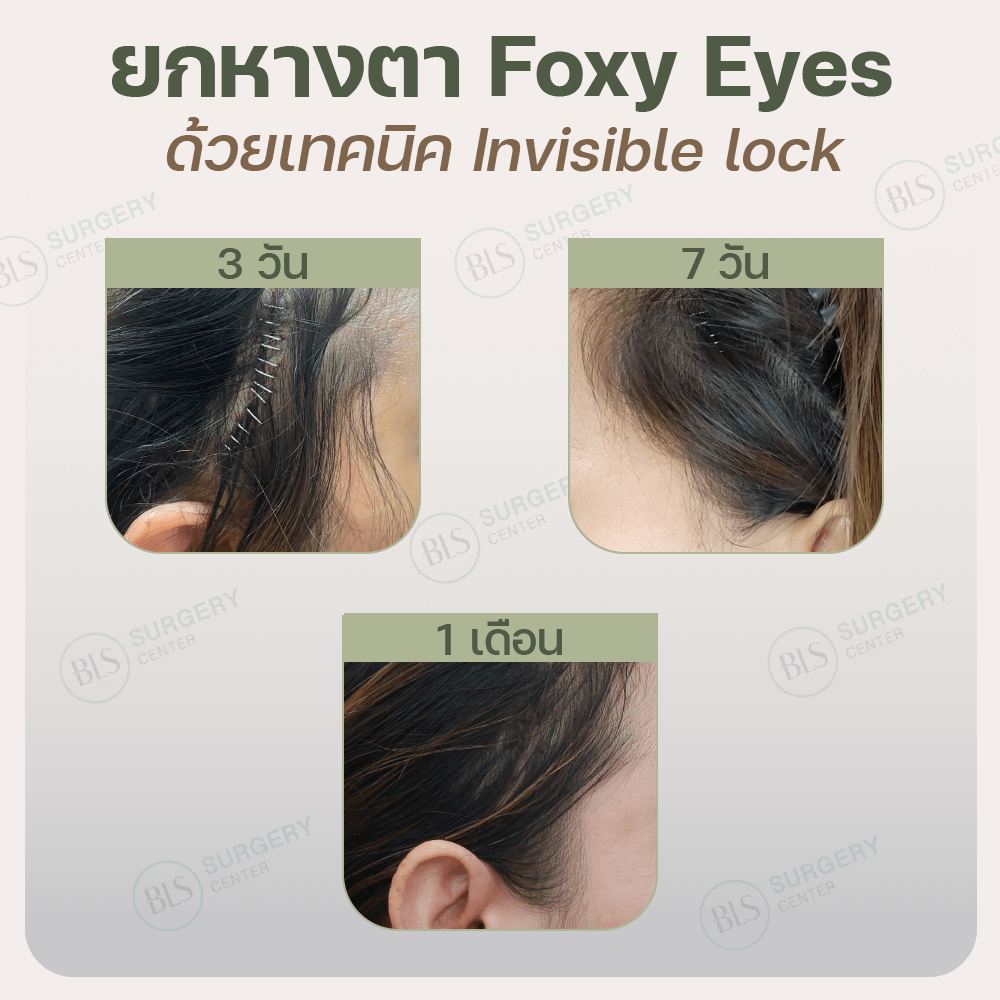 แผลผ่าตัด ยกหางตา (Foxy Eyes) เทคนิค Invisible lock