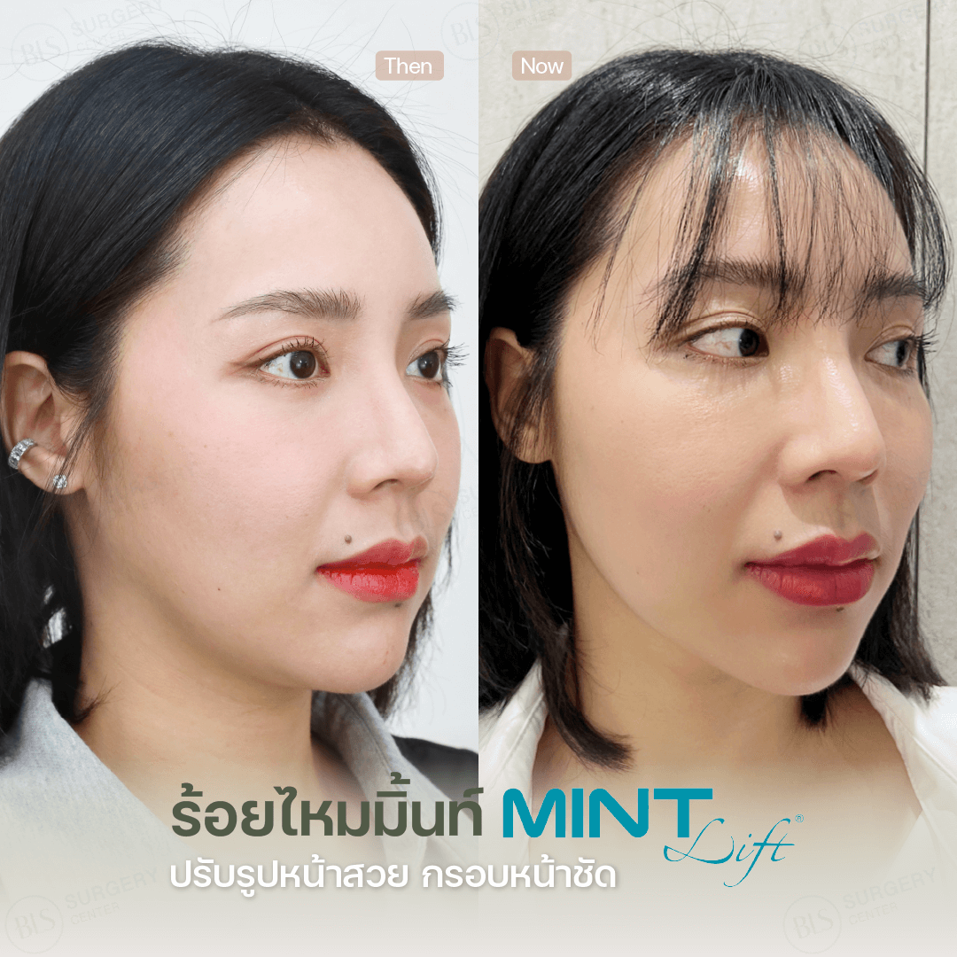 ไหมมิ้นท์ (Mint Lift) เหมาะกับใครบ้าง?