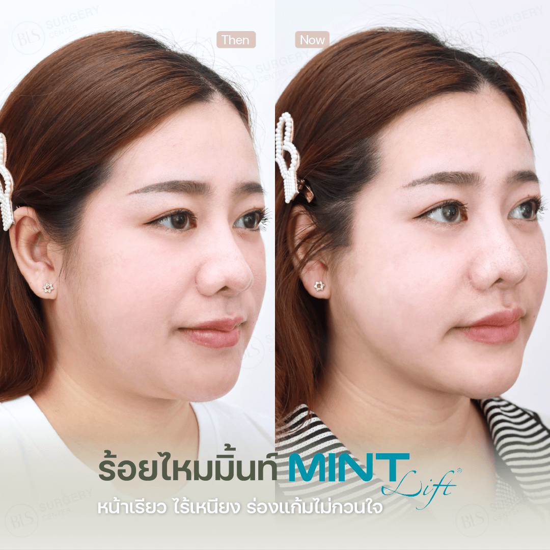 ไหมมิ้นท์ (Mint Lift) เหมาะกับใครบ้าง?