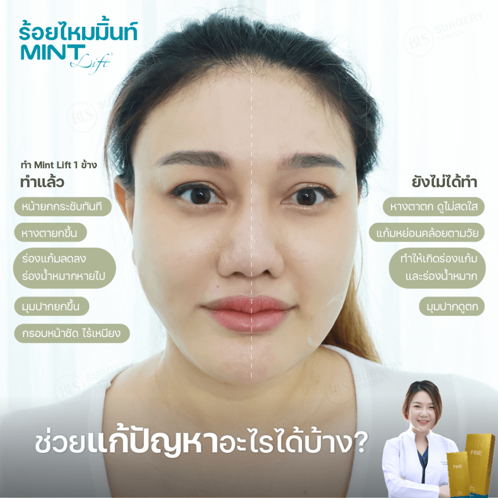 ไหมมิ้นท์ (Mint Lift) เหมาะกับใครบ้าง?