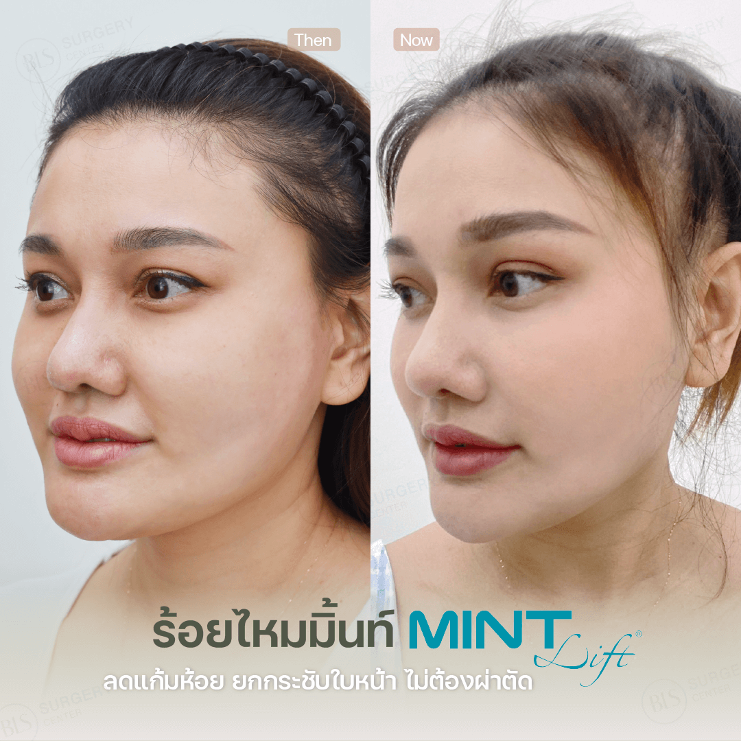 ไหมมิ้นท์ (Mint Lift) เหมาะกับใครบ้าง?