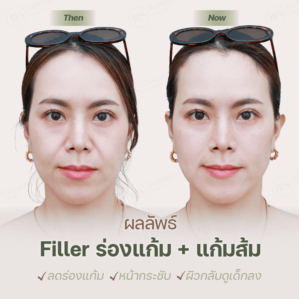 ผลลัพธ์หลังทำ Filler ฟิลเลอร์ ร่องแก้ม | ฉีดฟิลเลอร์