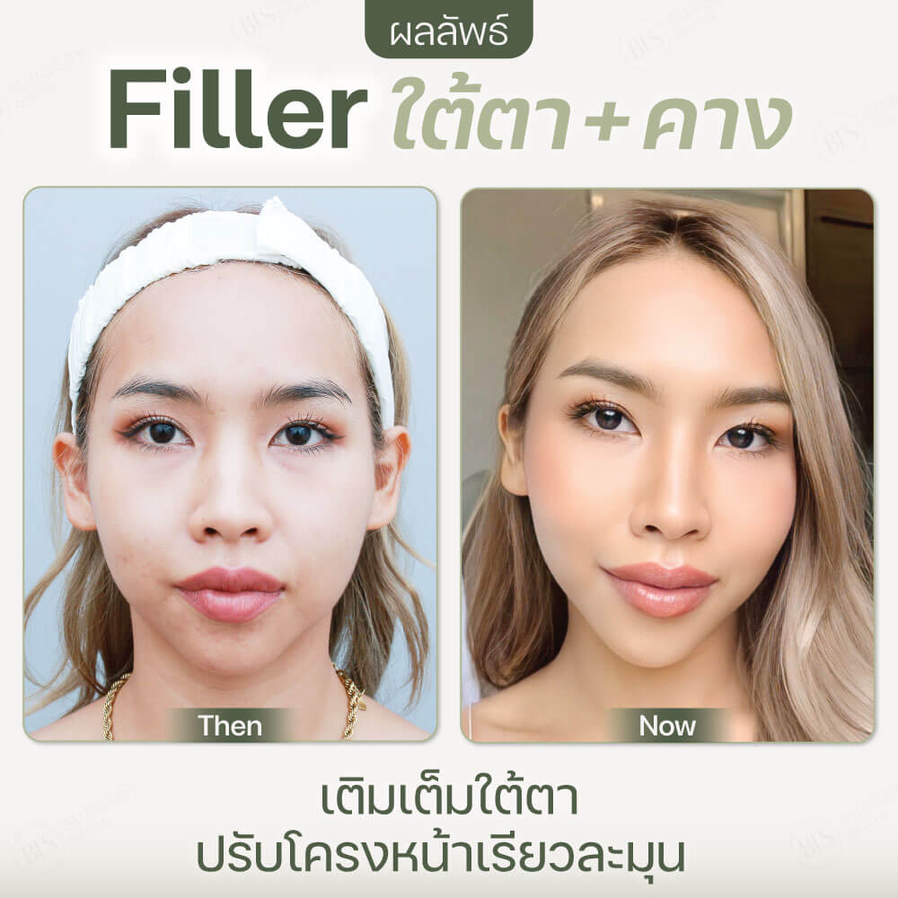 ผลลัพธ์หลังทำ Filler ฟิลเลอร์ ใต้ตา + คาง