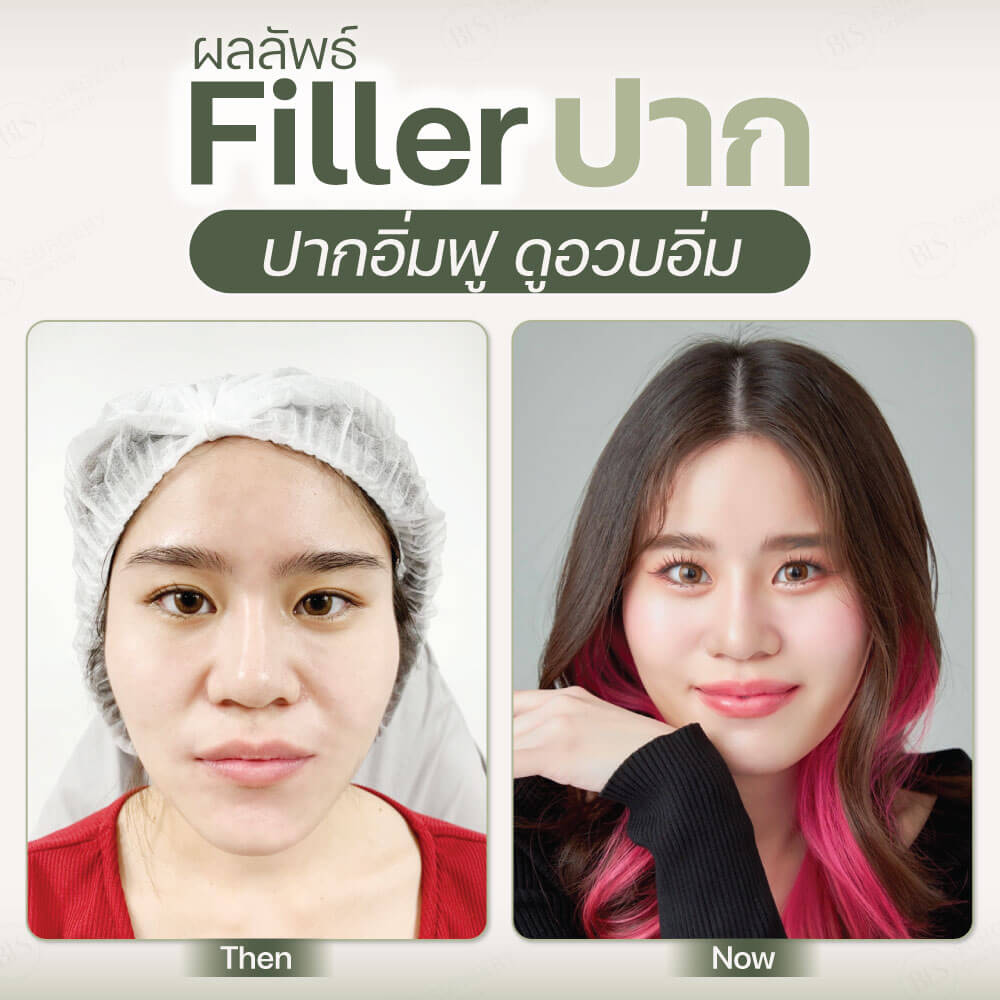 ผลลัพธ์หลังทำ Filler ฟิลเลอร์ ปาก