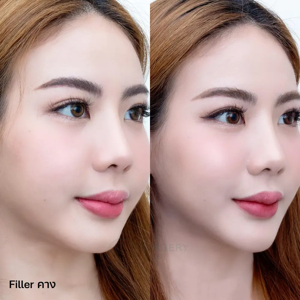 รีวิว Filler คาง