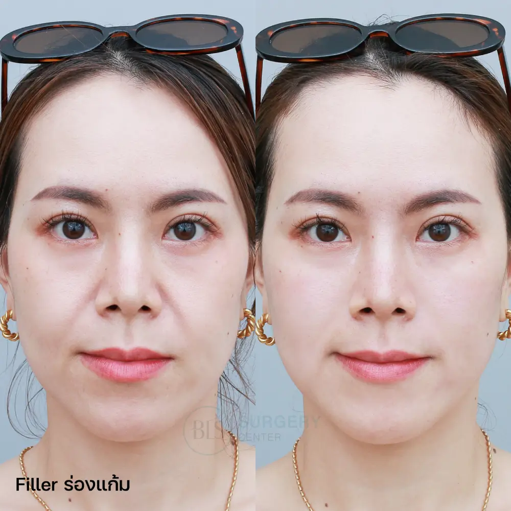 รีวิว Filler ร่องแก้ม