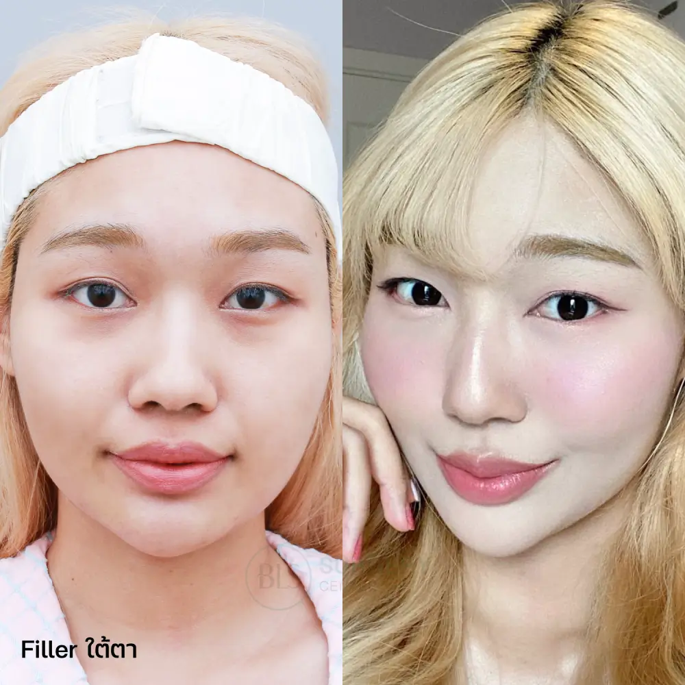 รีวิว Filler ใต้ตา