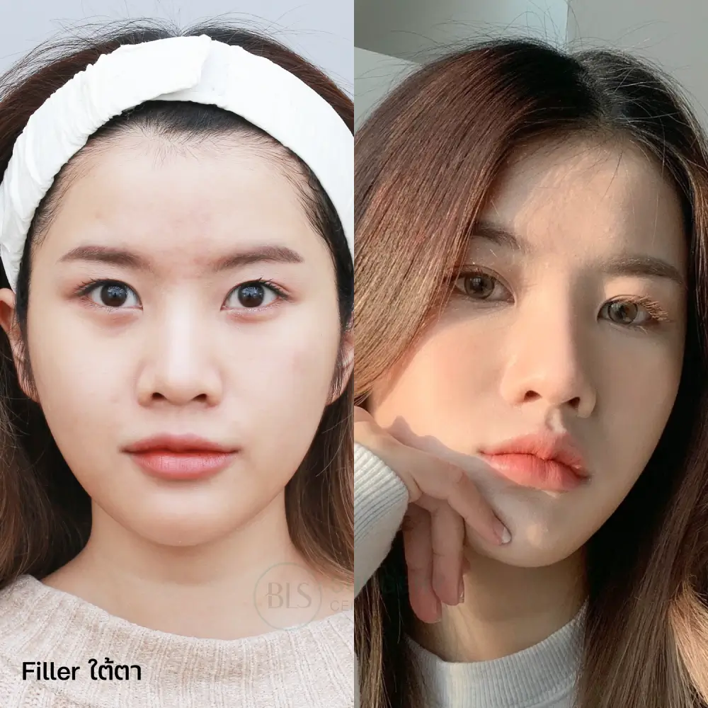 รีวิว Filler ใต้ตา