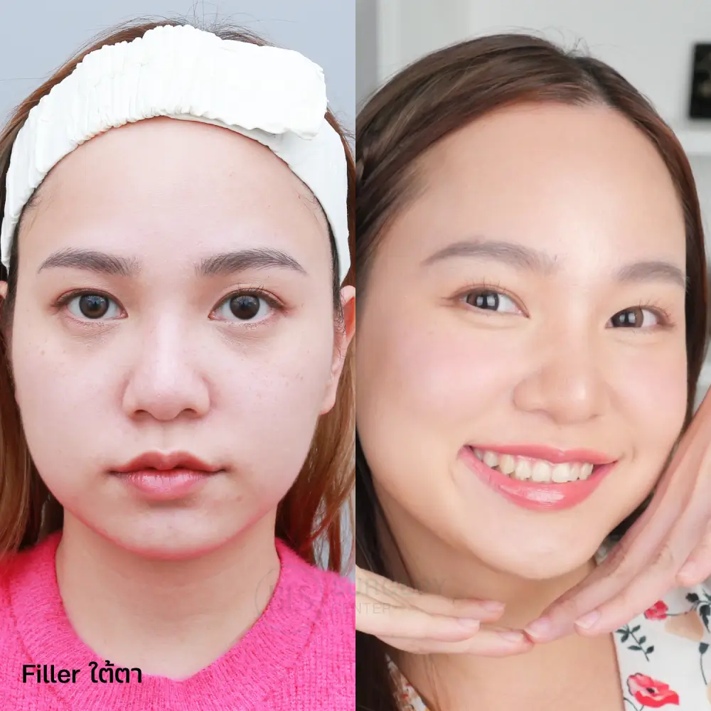 รีวิว Filler ใต้ตา