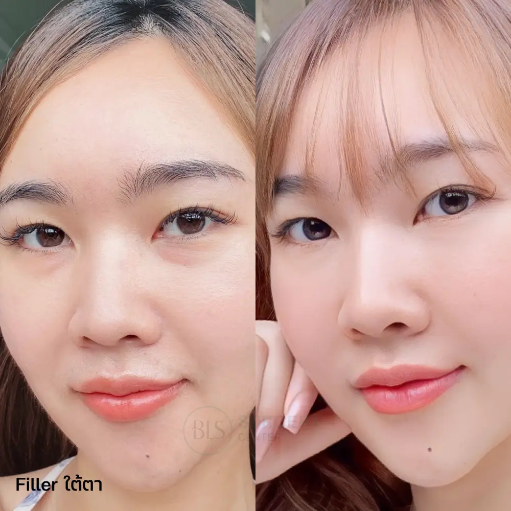 รีวิว Filler ใต้ตา