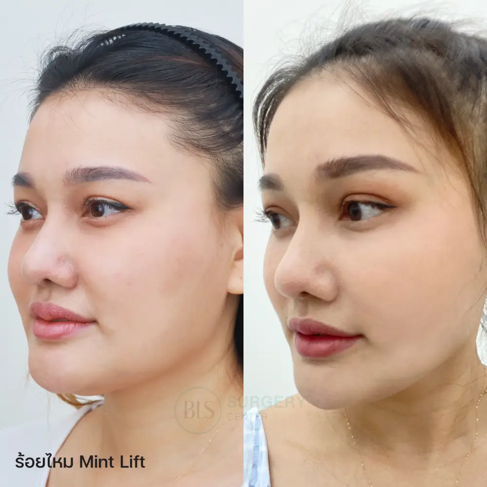 รีวิว ร้อยไหมมิ้นท์ Mint Lift